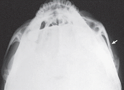 Zygomatic Arches Positioning